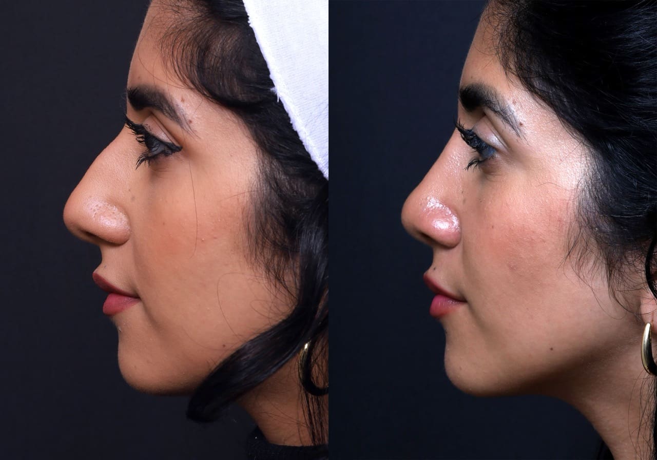 Rhinoplasty Journeys - Garcia Facial Plastic Surgery