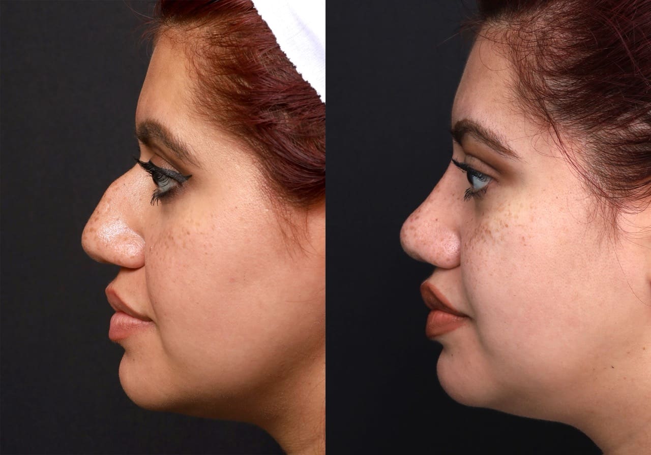 Rhinoplasty Journeys - Garcia Facial Plastic Surgery
