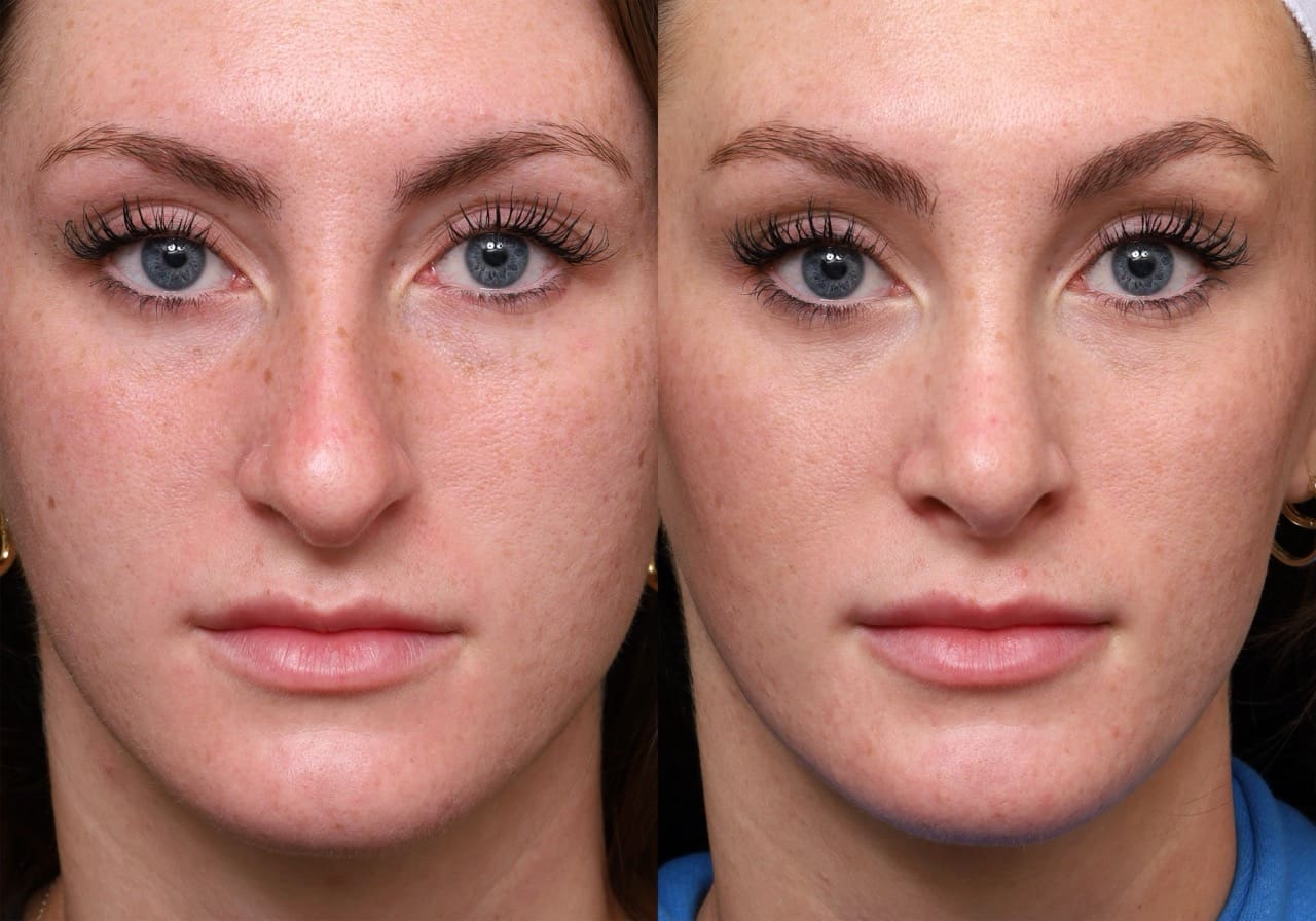 Rhinoplasty Journeys - Garcia Facial Plastic Surgery